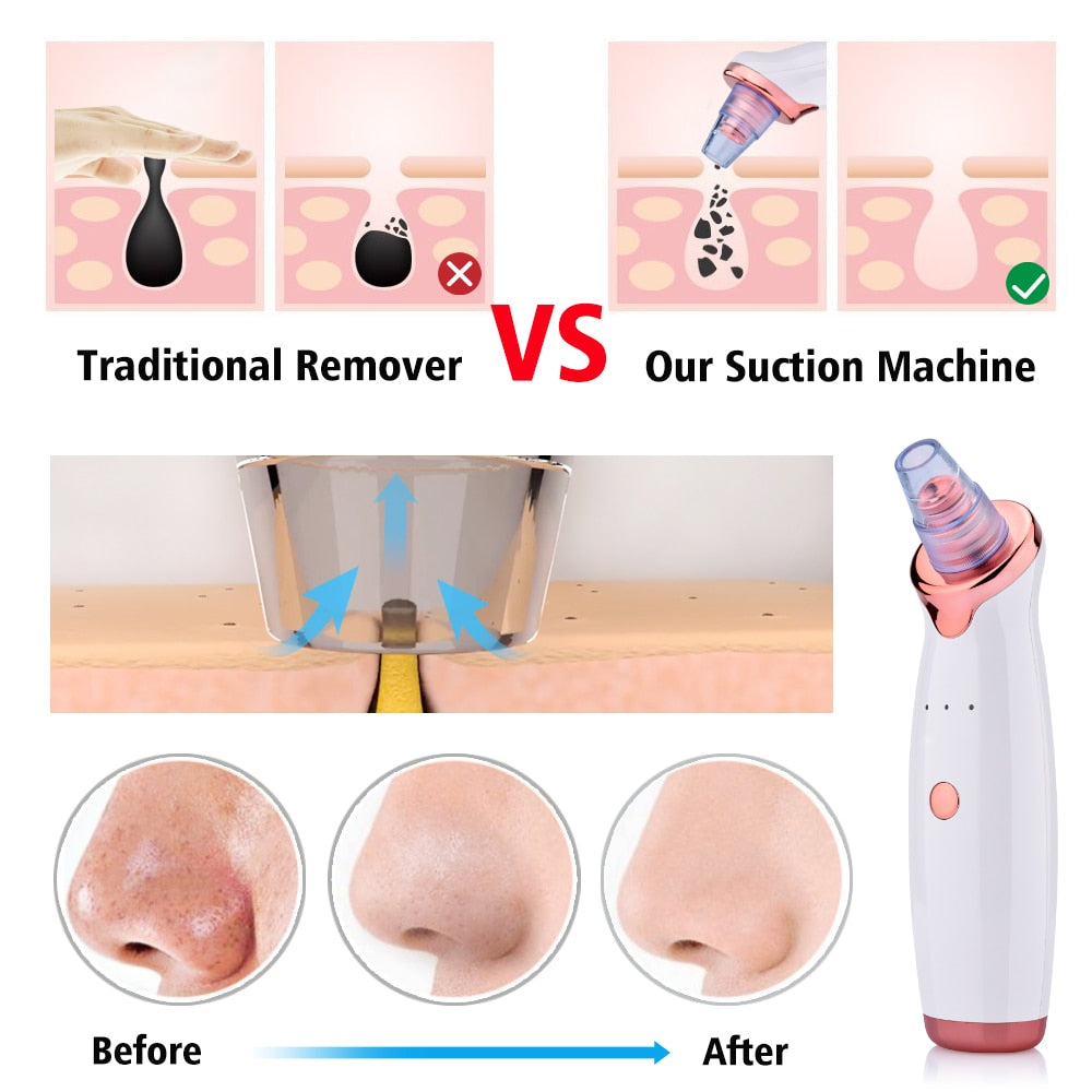 Blackhead Instrument Electric Suction Facial Washing hair removal exfoliating tool